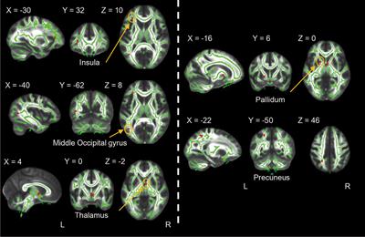 State-Independent Microstructural White Matter Abnormalities in Major Depressive Disorder